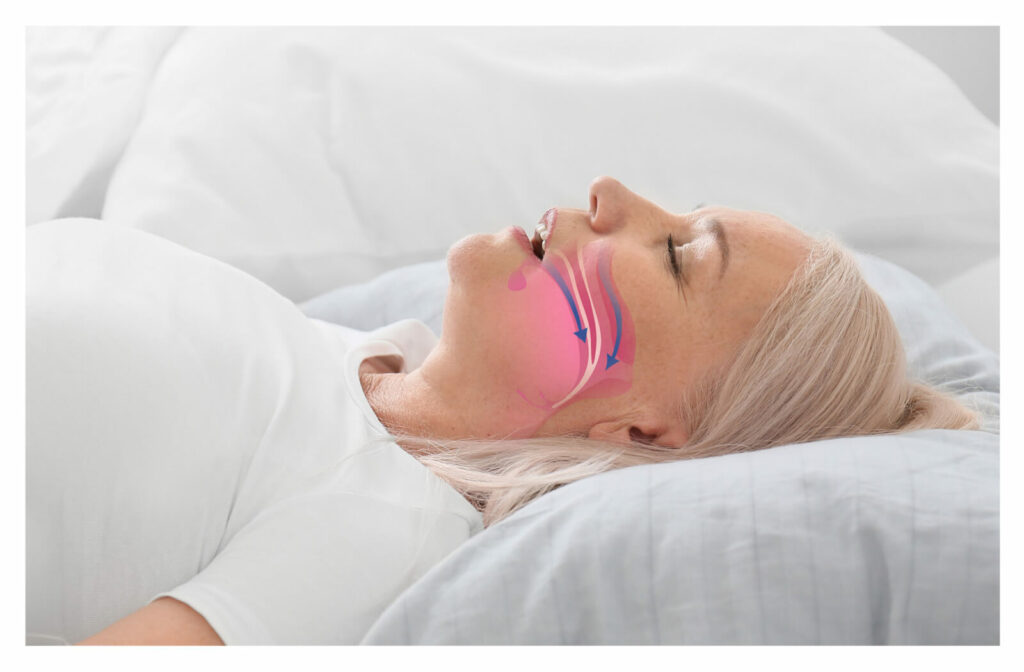 a woman lies on her back sleeping with her mouth open. there is a graphic overlay demonstrating sleep apnea breathing patterns on her face, with arrows pointing in and down towards her throat