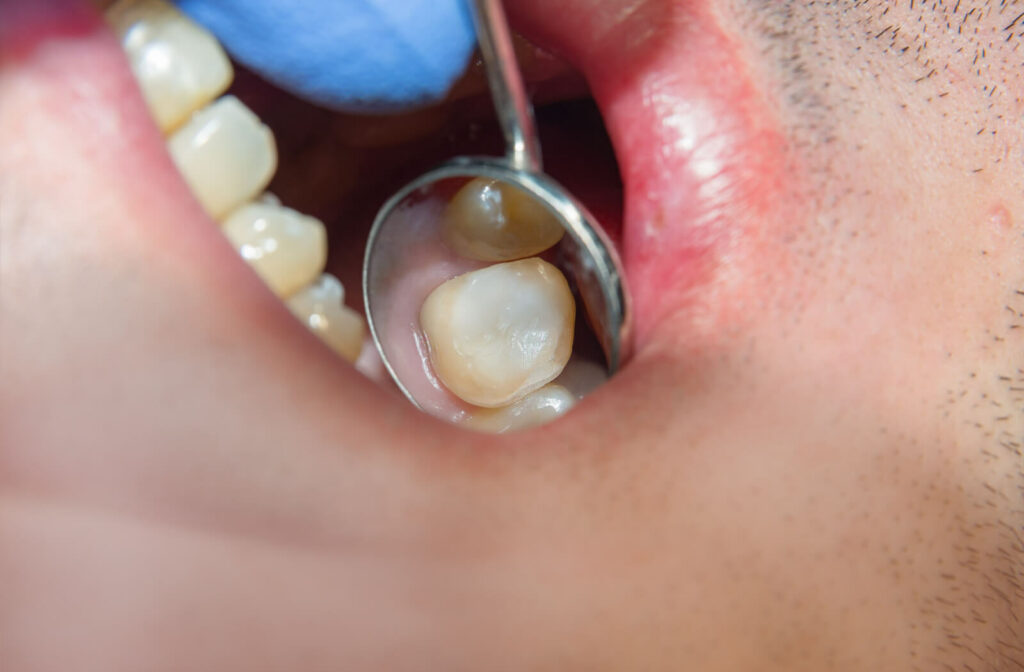 A man gets his tooth filled with resin after getting a root canal.