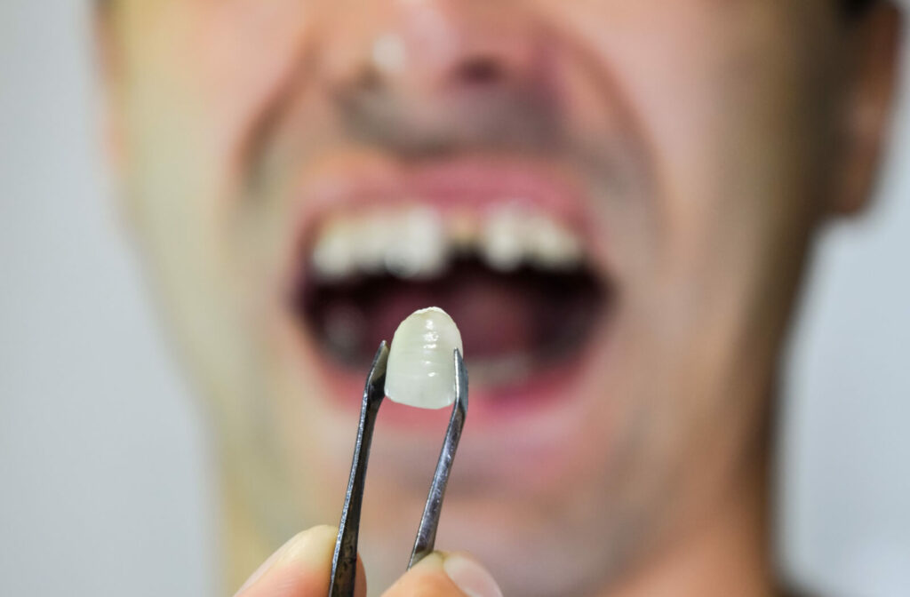 A man gets a new crown after a root canal to protect the week tooth from further damage.