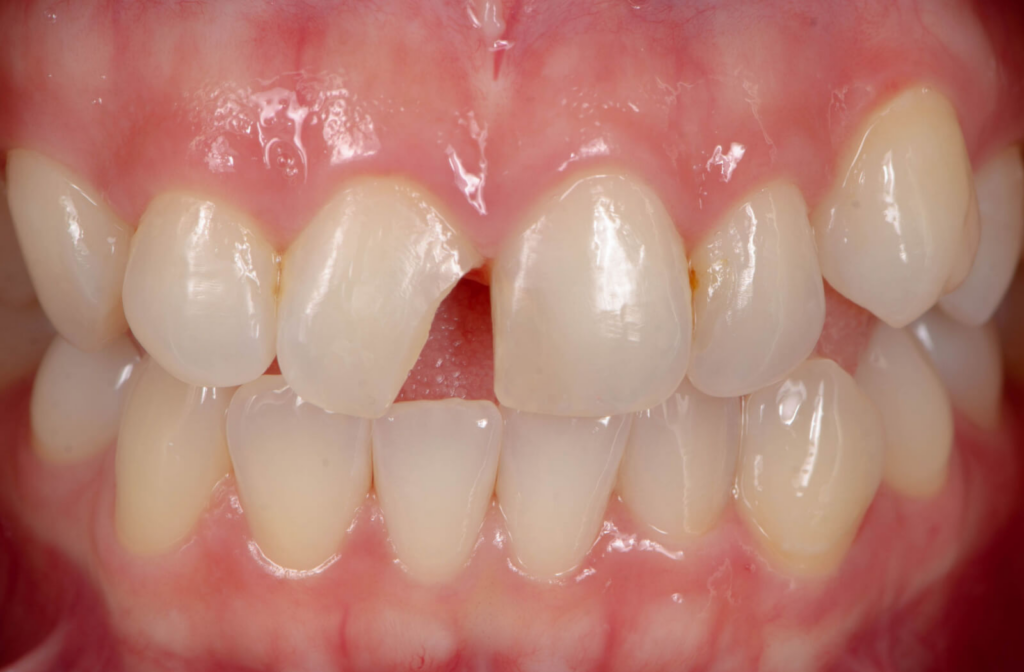 A close-up of a human gums and teeth  with a chipped tooth in the center