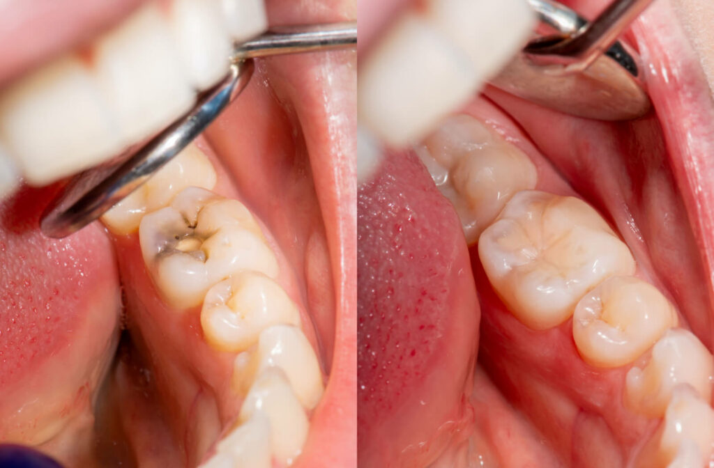 Close-up of a person's molar tooth showing before and after a filling