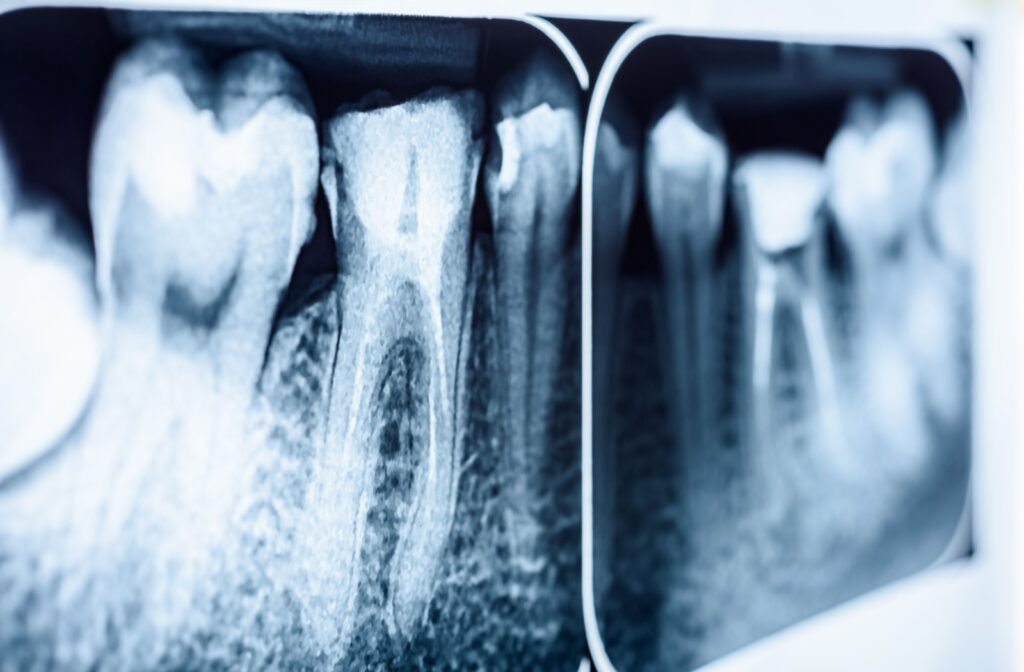 x-ray of teeth taken at the dentist