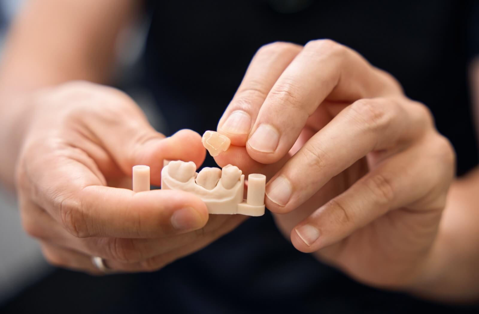 A 3D model showing how a dental crown works